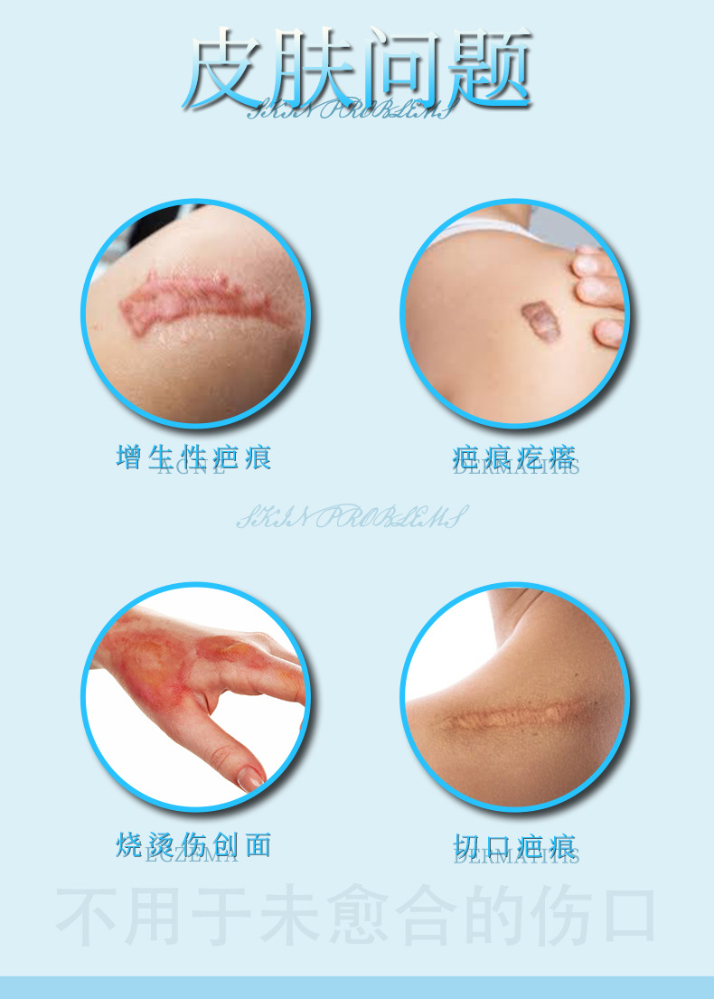 二类医疗器械疤痕修护液OEM 辅助改善皮肤病理性疤痕贴牌