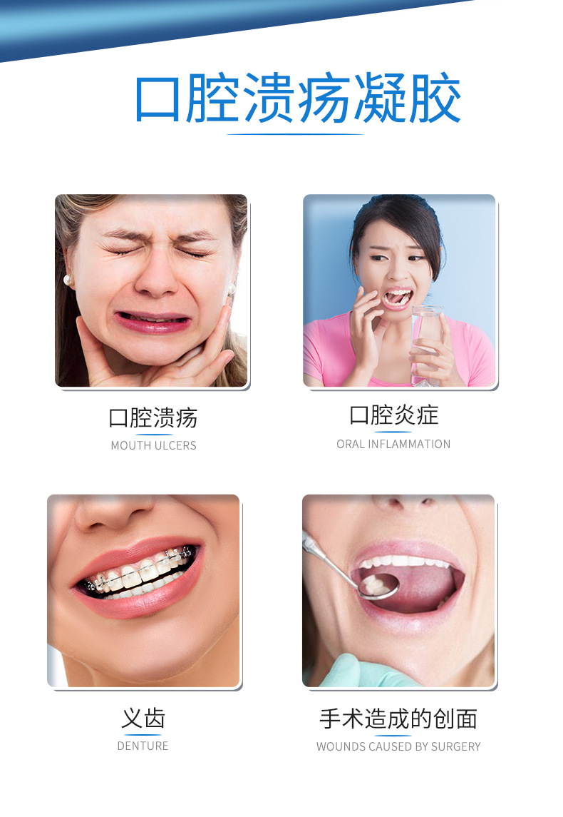 二类医疗器械口腔溃疡凝胶 缓解疼痛口腔溃疡炎症OEM贴牌代加工